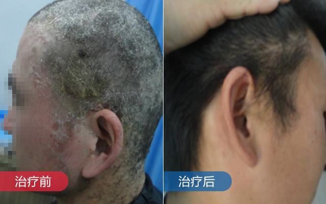 两年的头部银屑病,竟然在九天后好转?