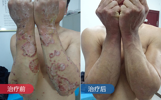 规范诊疗,击碎银屑病反复纠缠的魔爪