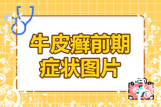 牛皮癣较佳治疗方法之温泉 ：真是不可思议！泡泡温泉银屑病居然好了