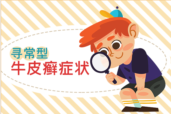 引发牛皮癣的原因有很多,这三大因素要注意!