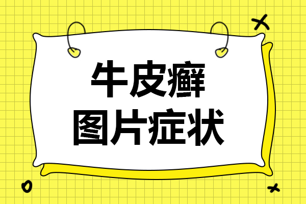 贵州银屑病治疗医院:银屑病的治疗费用和这三方面因素有关,你知道吗?